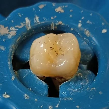 Dente estratto montato su un supporto blu, visto dall'alto prima dell'apertura