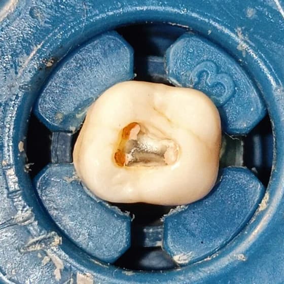 Il dente con gli imbocchi dei canali chiusi dal materiale di otturazione