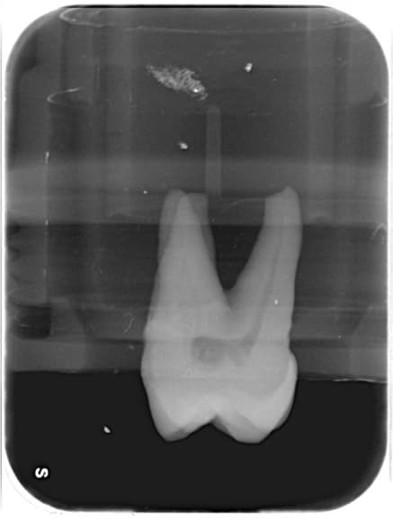 Radiografia del dente estratto con i canali radicolari non ancora otturati