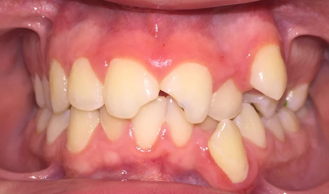 Vista frontale dei denti prima del trattamento ortodontico: denti affollati e sovrapposti