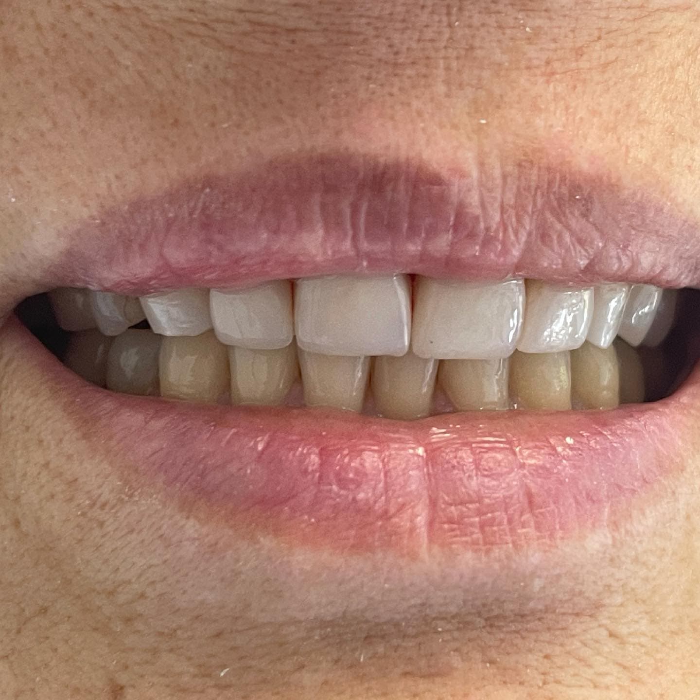 Risultato di un restauro dei denti anteriori.